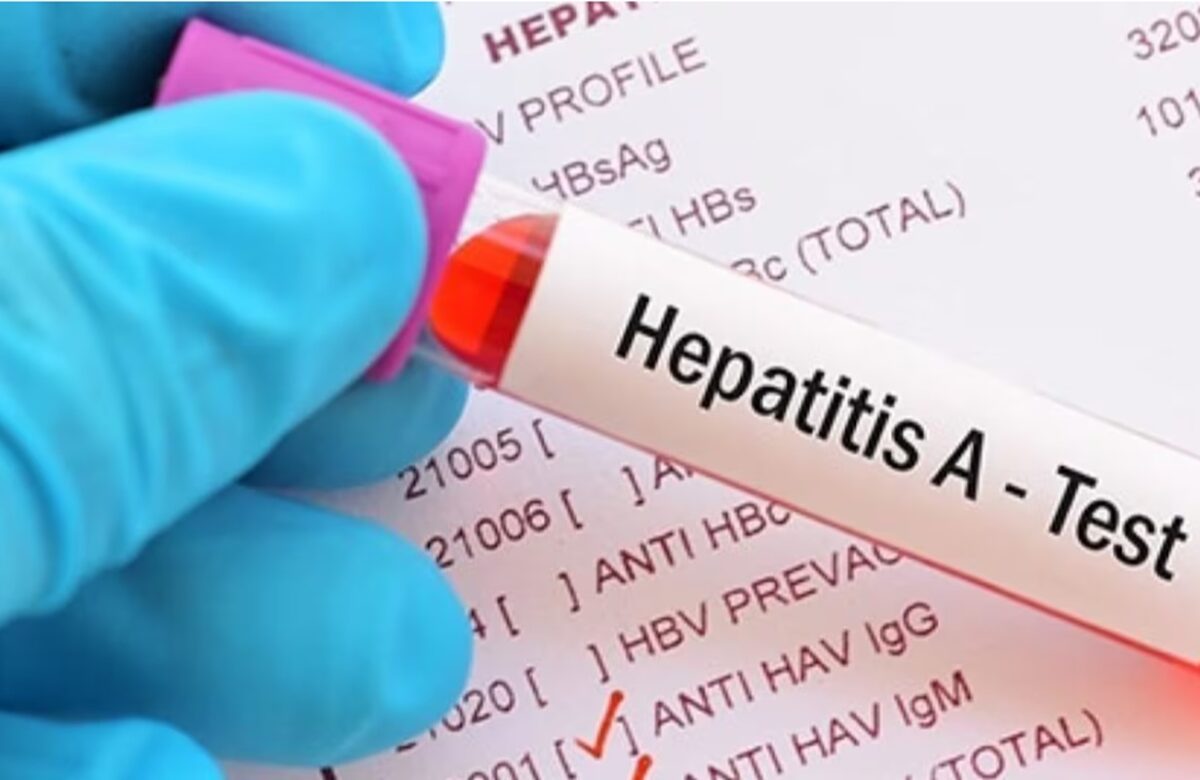 Brote de Hepatitis A