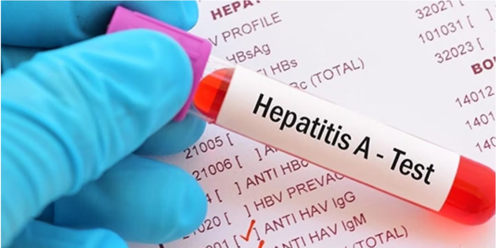Brote de Hepatitis A